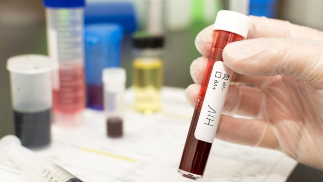Another Person Cured of HIV After Stem Cell Transplant