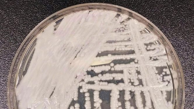 A Deadly Super-Fungus Is Spreading Fast in U.S. Hospitals and Care Homes