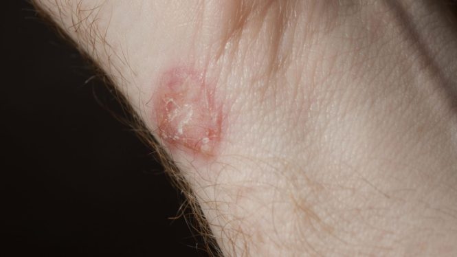 A Ringworm-Causing Superfungus Is Infecting People in New York City