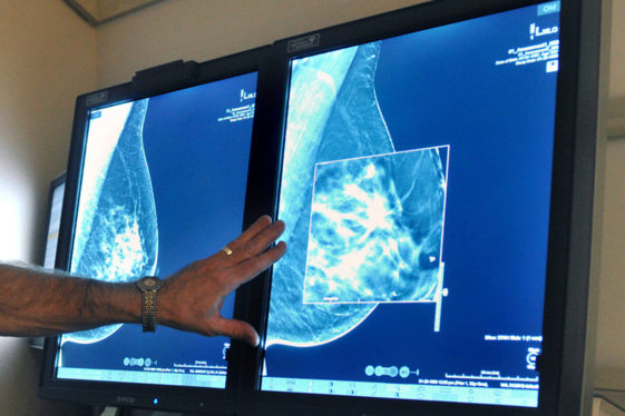 New Mammogram Advice: What to Know
