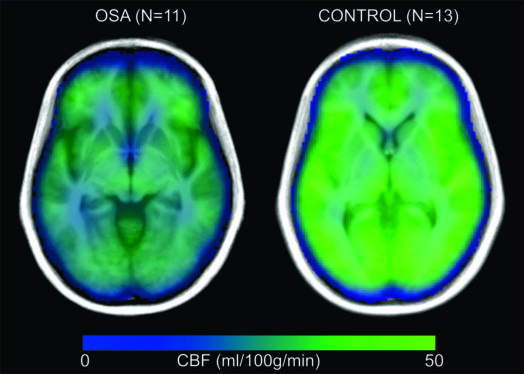 Sleep Apnea Linked to Brain Damage, Study Finds