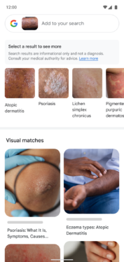 Google Lens can now search for skin conditions