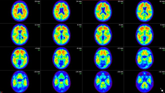 Eli Lilly drug shown to slow Alzheimer’s progression