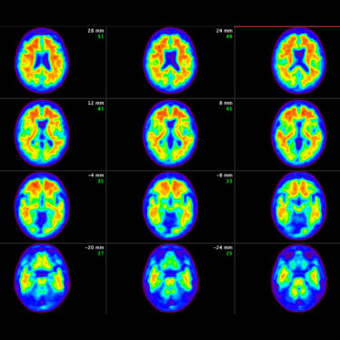 Treating Alzheimer’s Very Early Offers Better Hope of Slowing Decline, Study Finds