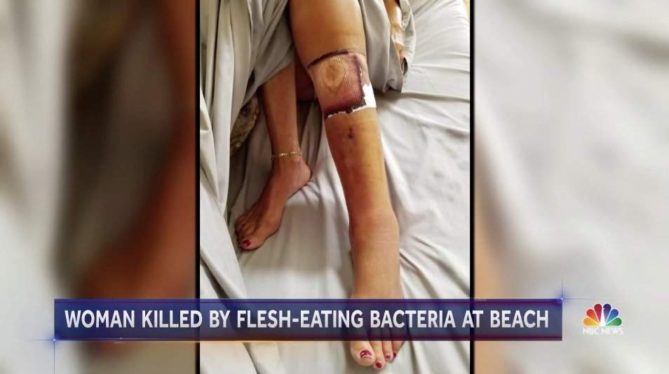 Flesh-Eating Bacteria at the Beach? What You Need to Know.