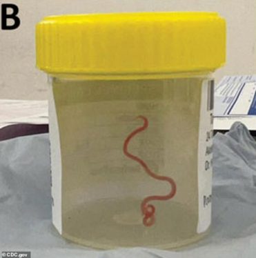 Woman’s mystery illness turns out to be 3-inch snake parasite in her brain