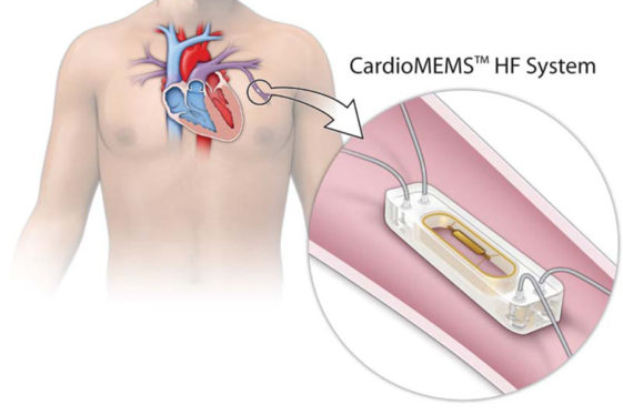 Biometric implant monitors transplant patients for organ rejection