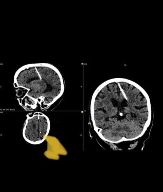 80-Year-Old Woman Has Lived Her Whole Life with a Needle in Her Brain