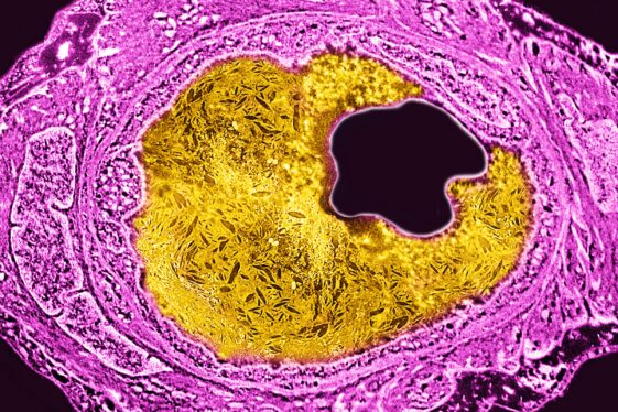 Crispr gene editing shown to permanently lower high cholesterol