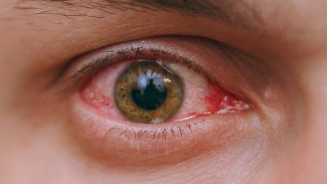 Five women got eye syphilis from the same man—raising questions