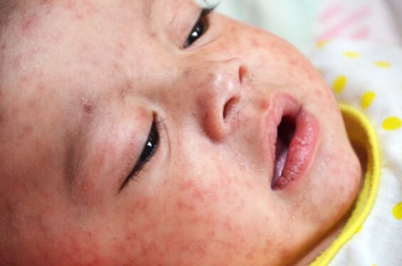 Measles rises globally amid vaccination crash; WHO and CDC sound the alarm