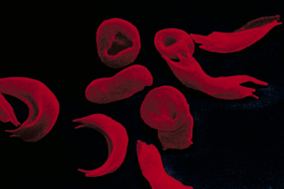 Sickle-Cell Treatment Created With Gene Editing Wins U.K. Approval