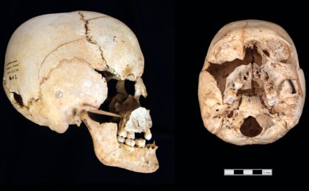 Scientists identify first known prehistoric person with Turner syndrome