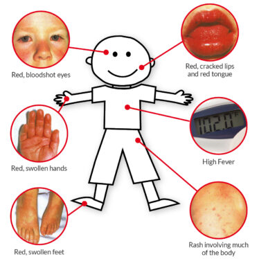 How to Spot Kawasaki Disease in Your Child