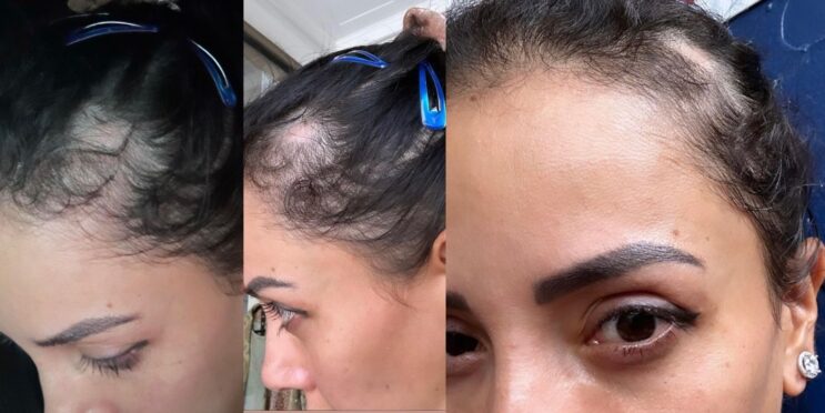 90 Day Fiancé: Jasmine’s Alarming Before & After Photos Showing Alopecia Hair Condition