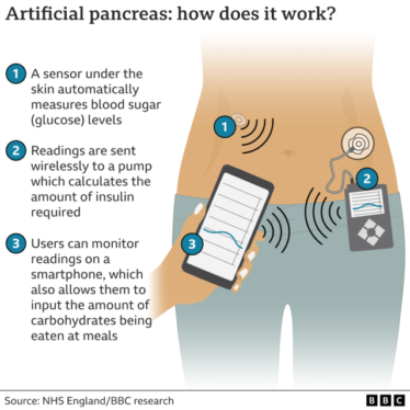 England’s NHS will provide artificial pancreas to thousands of diabetes patients