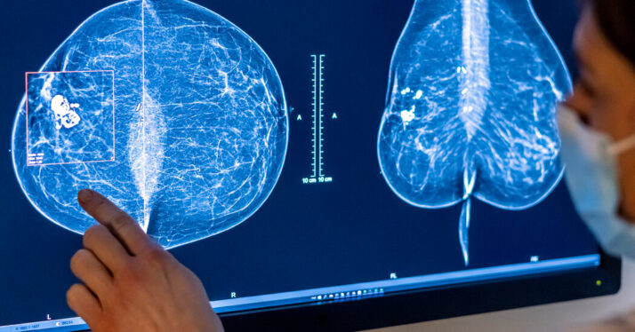 In Reversal, Expert Panel Recommends Breast Cancer Screening at 40