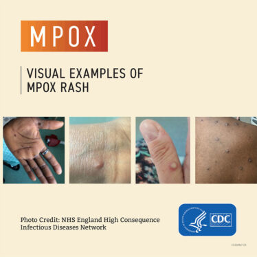 Mpox Outbreak: What to Know About Symptoms and Risks