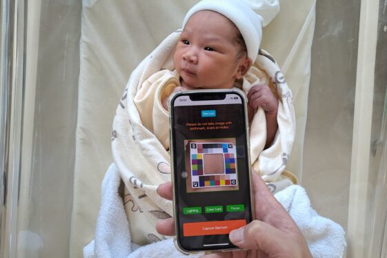 This AI app lets parents look for signs of infant jaundice at home